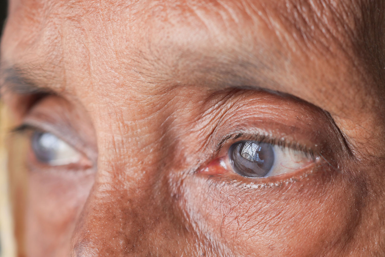 Jemm Optical Cataracts Management
