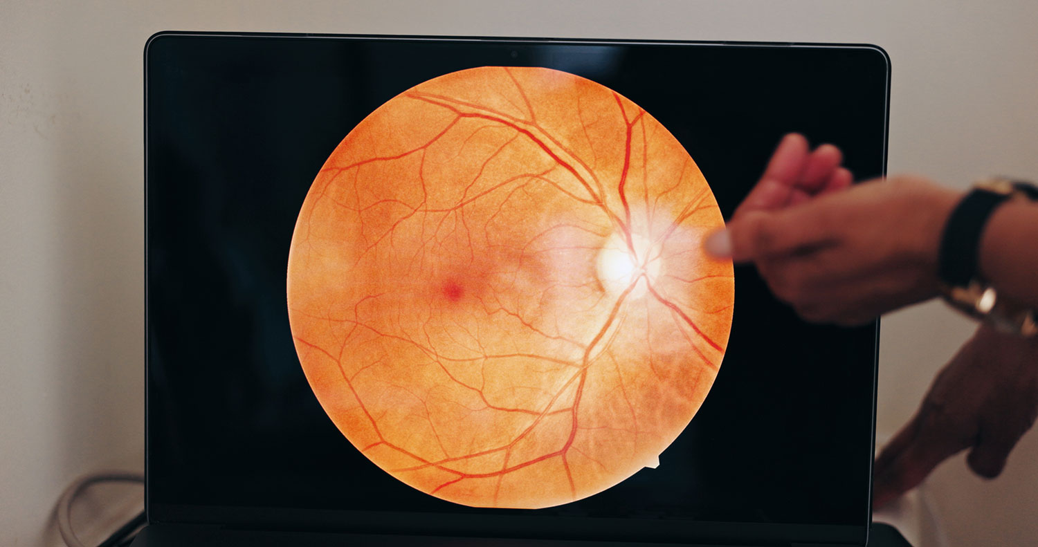 Retinal Imaging